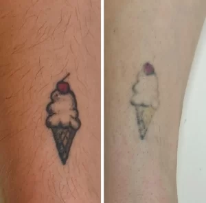 Laser Tattoo Removal