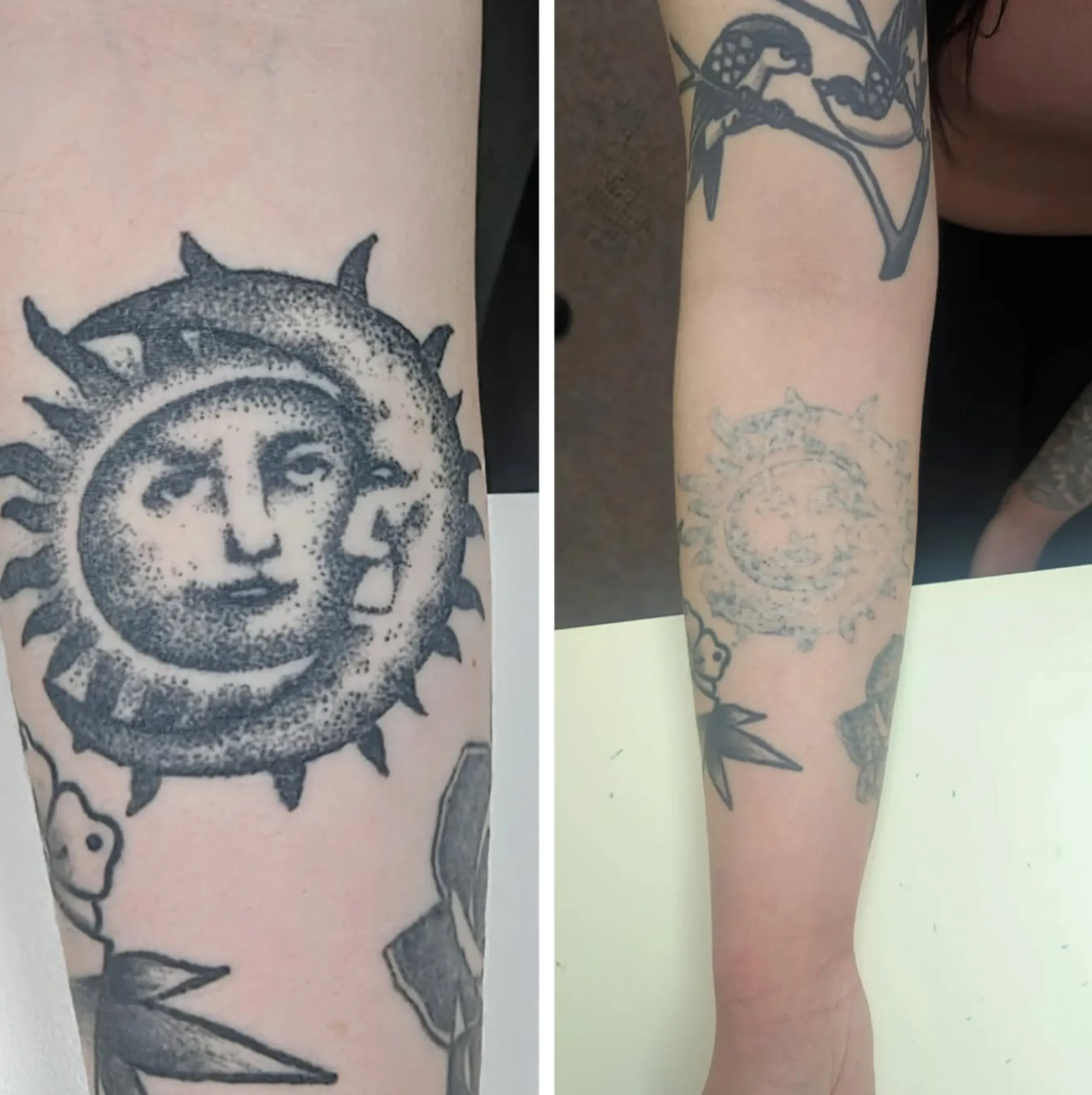 affordable tattoo removal melbourne