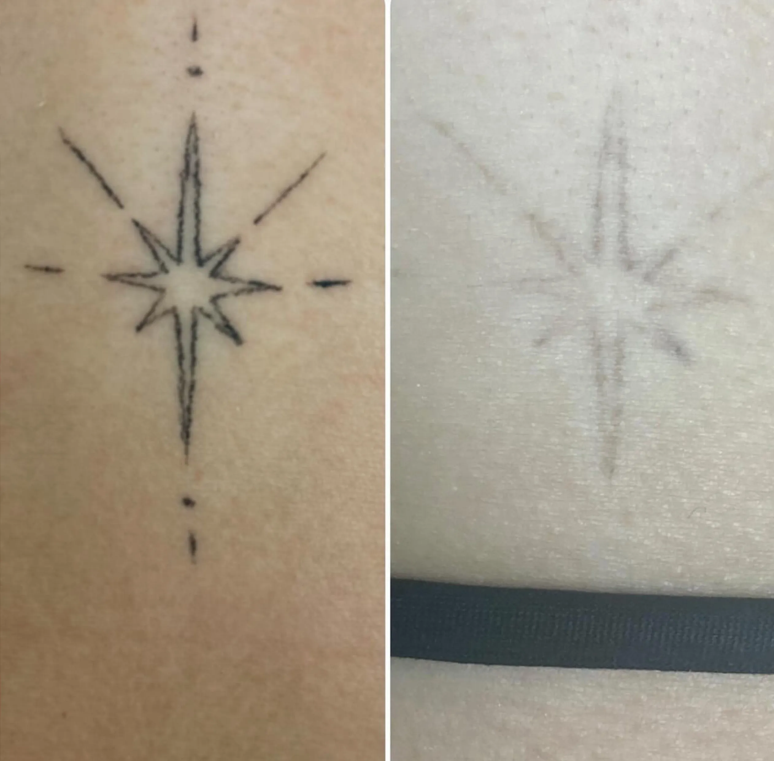 cost of laser tattoo removal