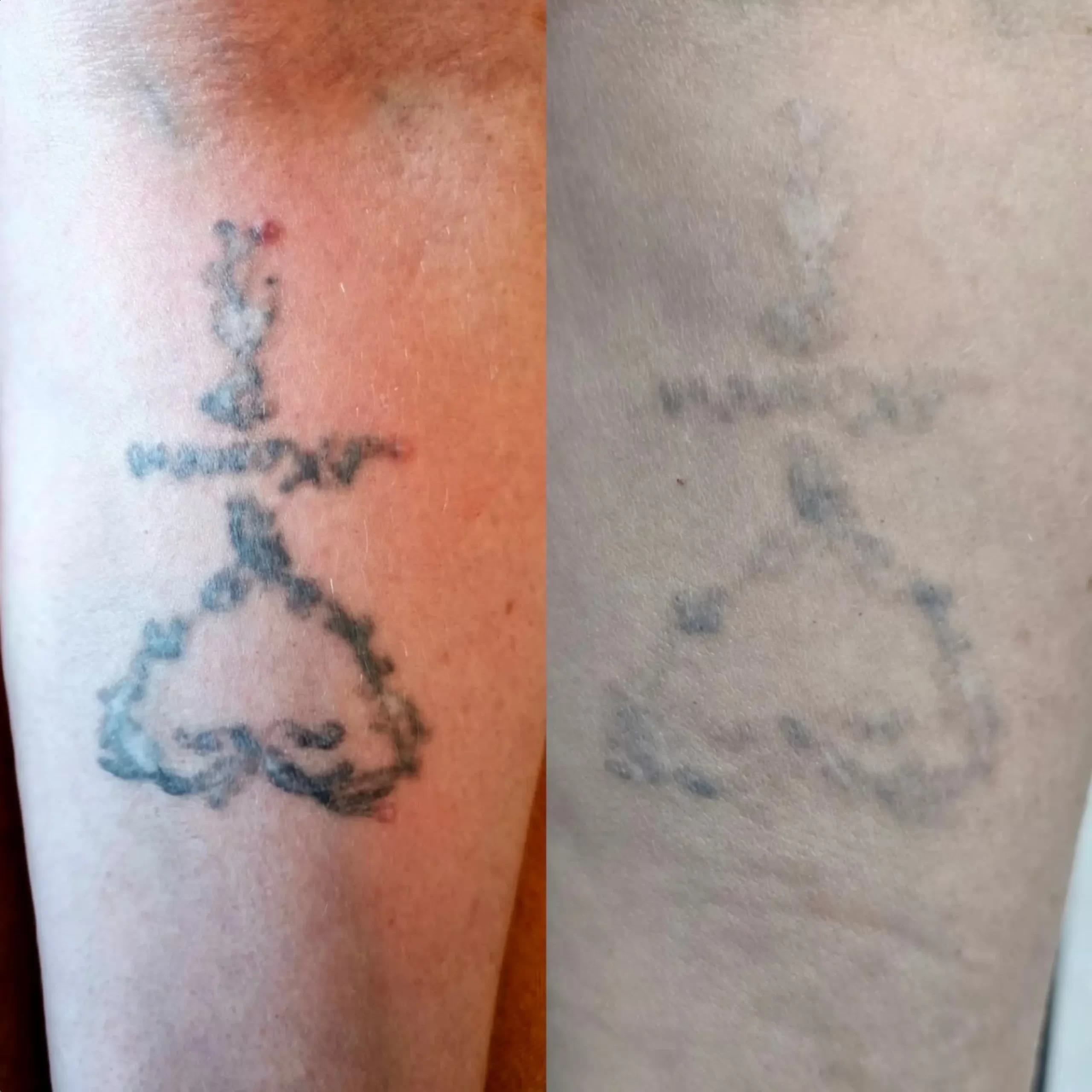 laser tattoo removal melbourne cbd