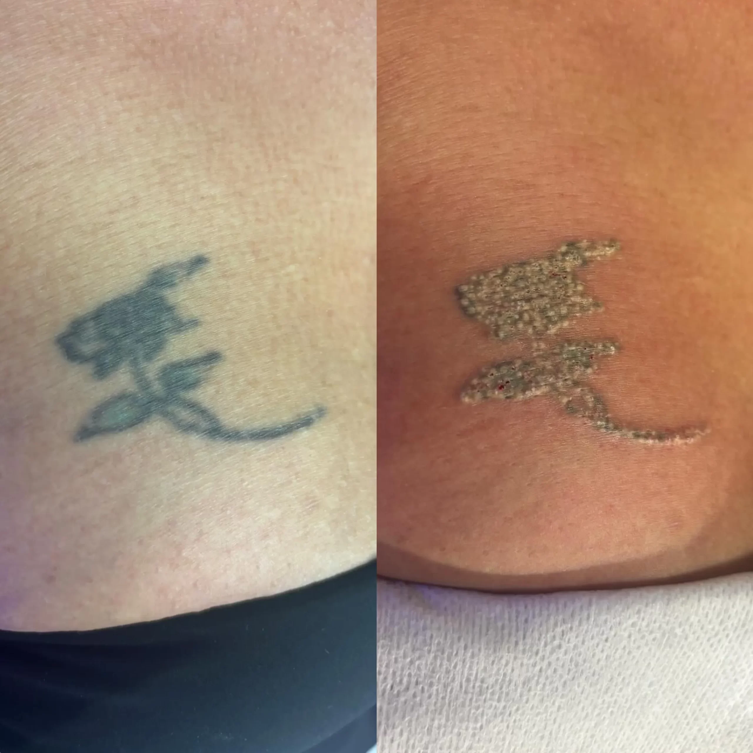 small tattoo removal