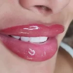 How to Reduce Swelling After Lip Tinting