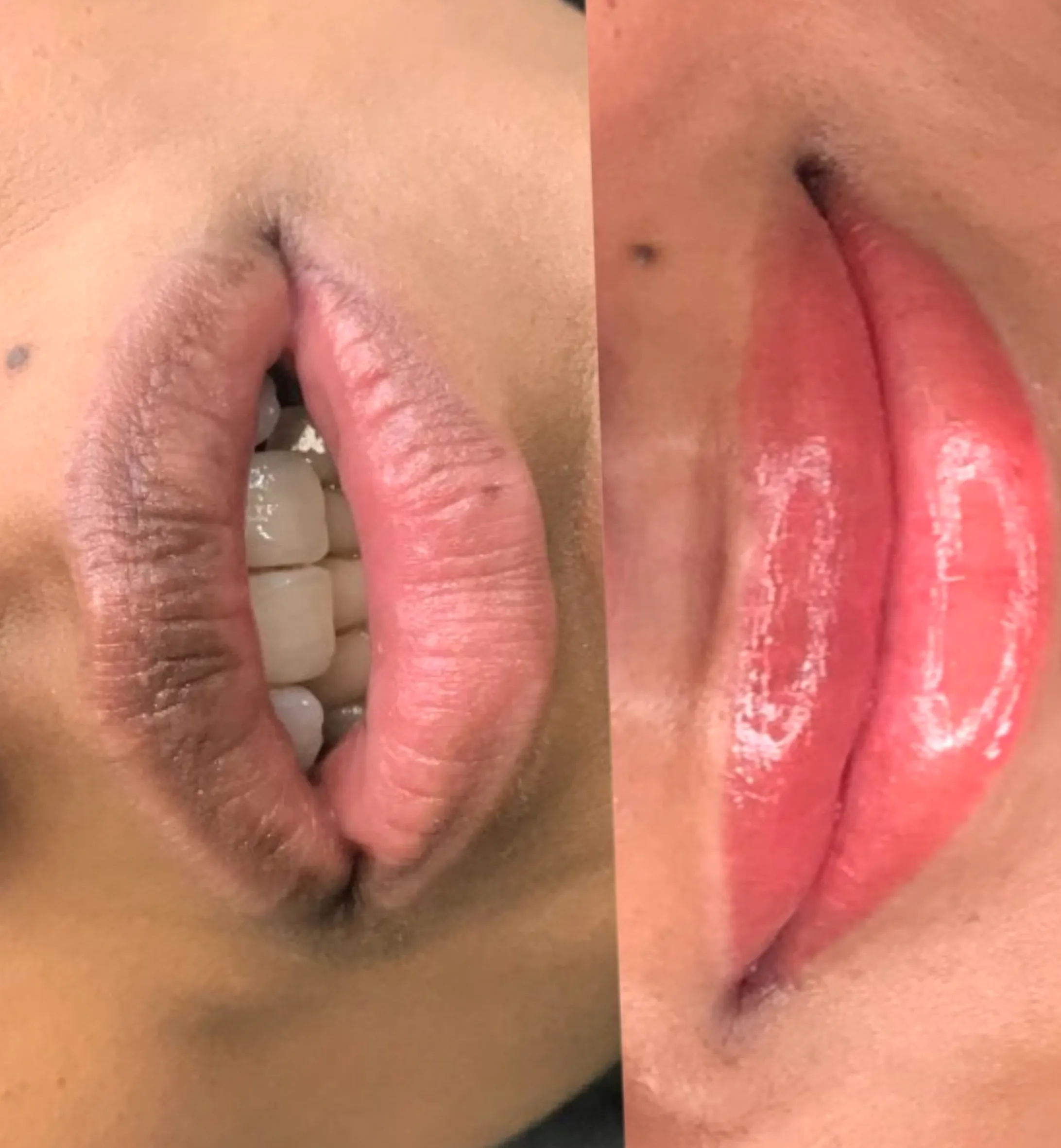 dark lip neutralisation training